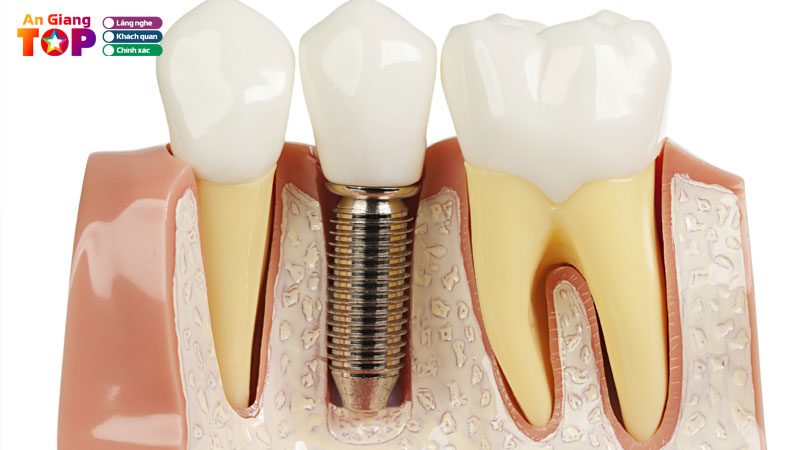 Top-6-dia-chi-trong-rang-implant-tai-an-giang-chuan-y-khoa-angiangtoplist