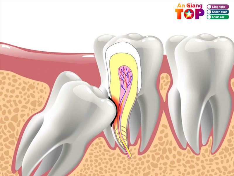 Nhung-ly-do-ma-ban-nen-nho-rang-khon-angiangtoplist