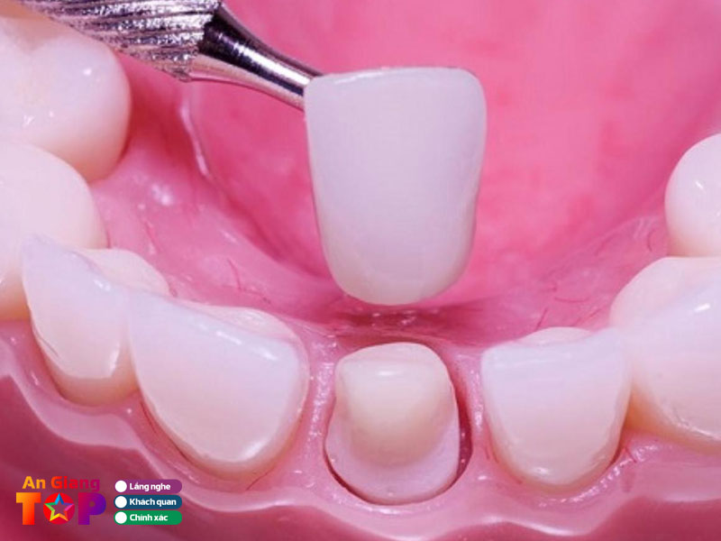 Tieu-chi-chon-dia-chi-boc-rang-su-uy-tin-angiangtoplist