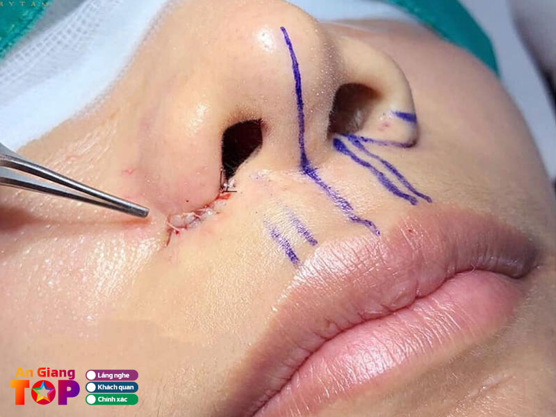 Nhung-luu-y-quan-trong-can-nho-sau-khi-thu-gon-canh-mui-angiangtoplist