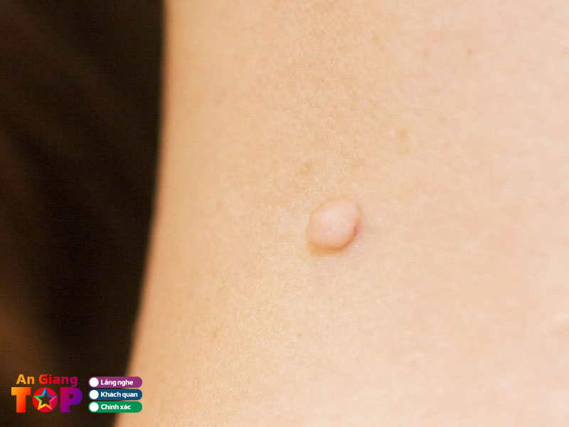 Kinh-nghiem-cham-soc-da-sau-khi-xoa-mun-thit-1-angiangtoplist