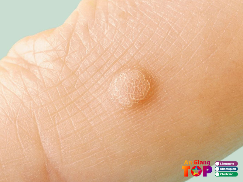 Tieu-chi-chon-dia-chi-dieu-tri-sui-mao-ga-uy-tin-angiangtoplist