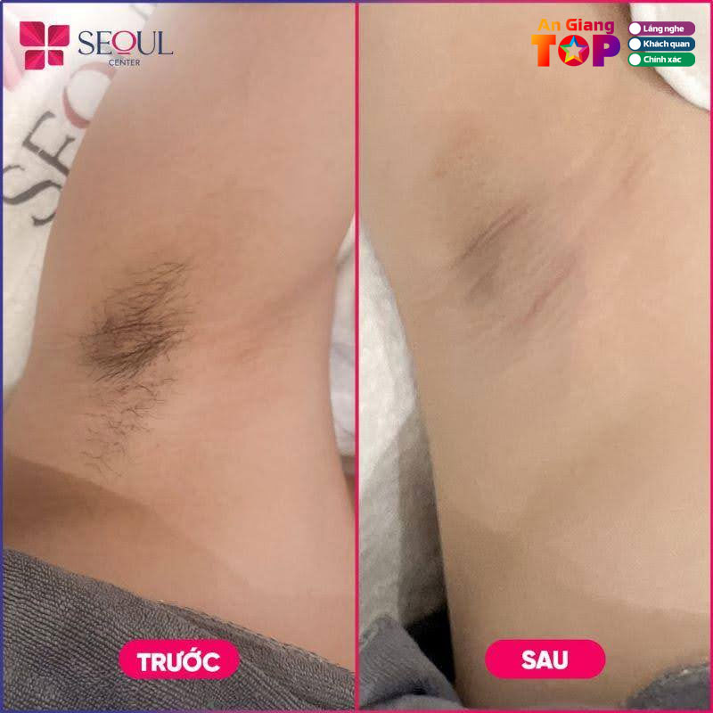 Tham-my-vien-seoul-center-dia-chi-triet-long-nhe-nhang-an-toan-2-angiangtoplist