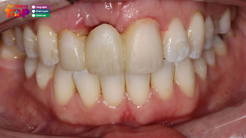 Cau-rang-su-giai-phap-phuc-hinh-rang-nhanh-chong-va-on-dinh-2-angiangtoplist