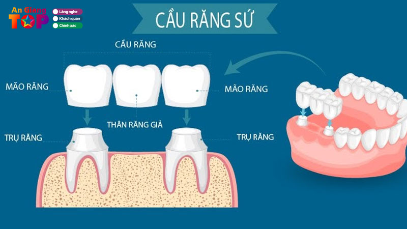 Cau-rang-su-giai-phap-phuc-hinh-rang-nhanh-chong-va-on-dinh-angiangtoplist