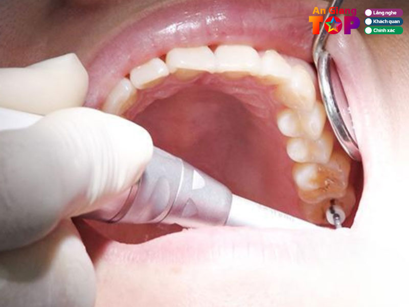 Dau-hieu-ban-can-dieu-tri-tuy-rang-cang-som-cang-tot-angiangtoplist