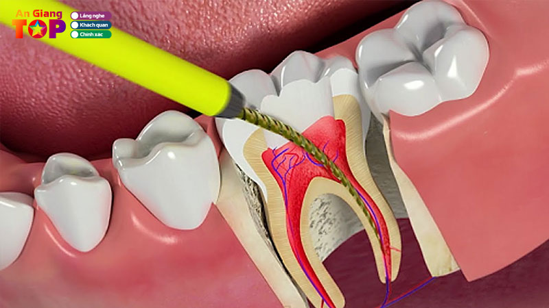Top-10-nha-khoa-dieu-tri-tuy-rang-o-an-giang-an-toan-hieu-qua-cao-angiangtoplist